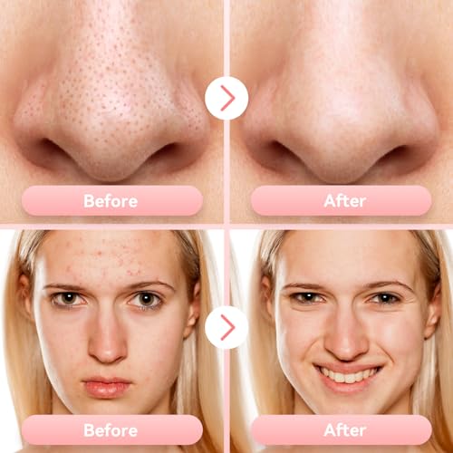 Blackhead Remover Pore Vacuum, Blackhead Vacuum, Facial Pore Cleaner with 5 Adjustable Suction Levels, 5 Probes, USB Rechargeable Pore Cleaner, Electric Comedone Whitehead Extractor Tools Kit