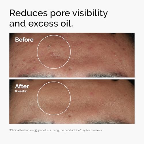 The Ordinary Serum Favorites Set – Hyaluronic Acid 2% + B5, Niacinamide 10% + Zinc 1%, Caffeine Solution 5% – Eye and Face Serums for Hydrating, Brightening & Pore-Minimizing Skin Care