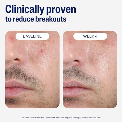 Cetaphil Gentle Clear Complexion-Clearing BPO Acne Cleanser with 2.6% Benzoyl Peroxide, Creamy and Soothing for Sensitive Skin, Suitable for All Skin Types, 4.2oz