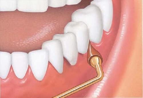 GUM Stimulator 1 Each (Pack of 5)