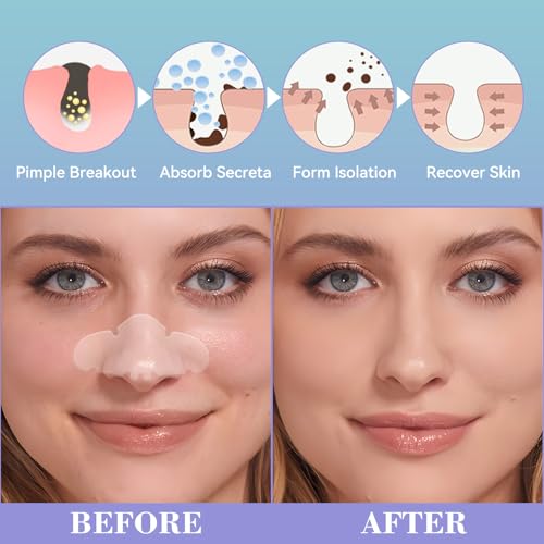 Nose Pore Patches, Hydrocolloid Nose Patches, Targets Pimple, Pores & Oil (10 Pack)
