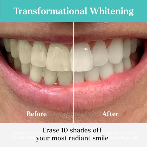 GLO Science So Brilliant Tooth Whitener Set – Unique Heat Technology for Fast, Sensitivity Free Teeth Whitening – Patented Mouthpiece with LED Light, Gel Pods with 6% HP, Lip Balm, & Travel Case