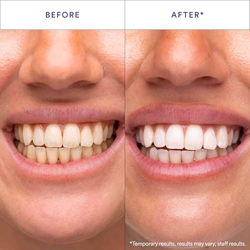 Hismile V34 Whitening Strips, Teeth Whitening Strips, Purple Tooth Whitening, Purple V34 Whitening Strips, Tooth Stain Treatment, Combining Whitening and Colour Correction