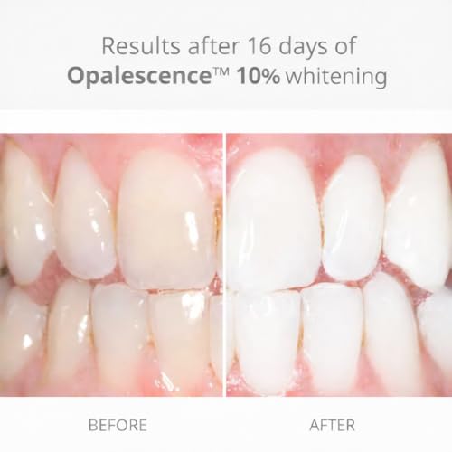 Opalescence 10% Gel Syringes Teeth Whitening - Refill Kit (4 Syringes Total) Carbamide Peroxide. Made by Ultradent, in Melon Flavor. Tooth Whitening Refill Syringes