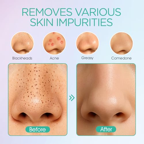 VOYOR Blackhead Remover Pore Vacuum - Electric Face Vacuum Pore Cleaner Acne White Heads Removal with 6 Suction Heads (BR410)