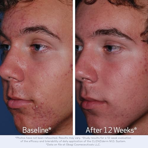 Obagi CLENZIderm M.D. Daily Care Foaming Acne Cleanser – Acne Treatment with 2% Salicylic Acid (BHA)