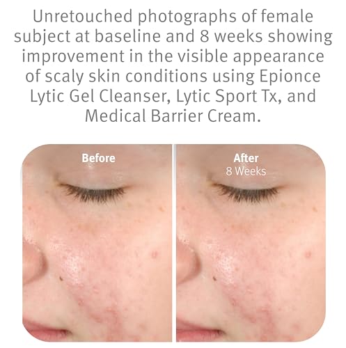 Epionce Lytic Gel Cleanser – Gentle Foaming Face Wash & Makeup Remover | For Oily, Combination & Problem Skin | Acne & Oil-Control Cleanser with Willow Bark | Dermatologist Skincare