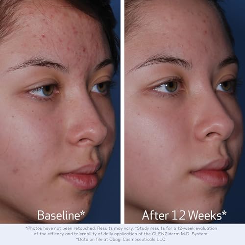 Obagi CLENZIderm M.D. Daily Care Foaming Acne Cleanser – Acne Treatment with 2% Salicylic Acid (BHA)