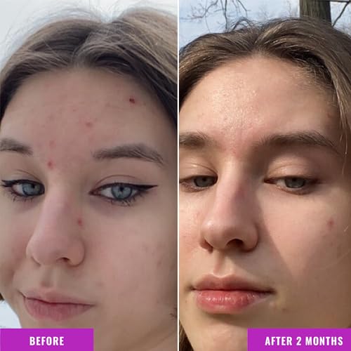 Good Molecules Niacinamide Serum - 10% Niacinamide to Target Blemishes, Nourishment, and Skin Tone - Ultra Hydrating Serum and Brightening Skin Care for Face