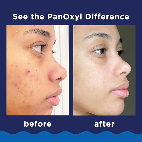 PanOxyl Acne Foaming Wash Benzoyl Peroxide 10% Maximum Strength Antimicrobial, 5.5 Ounce (Pack of 1)