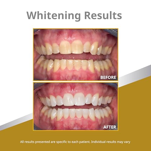 Opalescence 45% Syringes Teeth Whitening Gel - with PF - (4 Syringes) Refill Kit Carbamide Peroxide. Made by Ultradent, in Mint Flavor. Tooth Whitening 5359-2