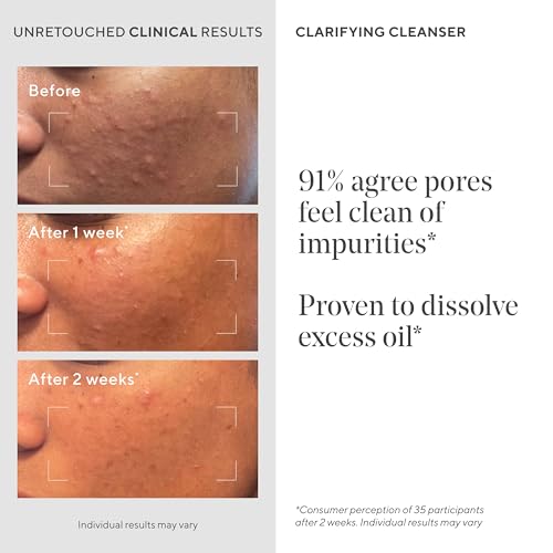 Murad Acne Control Clarifying Cleanser – Salicylic Acid & Green Tea Formula for Acne, Deep Pore Cleansing, Oil Control & Breakout Prevention for Clear, Balanced, Healthy-Looking Skin (5 Fl Oz)