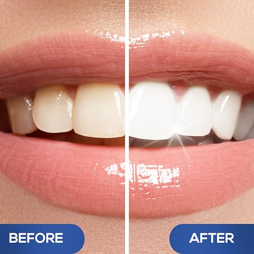 Venus Visage Award Winning Teeth Whitening Pen, 20+ Uses - Teeth whitening Gel Professionally formulated - Best Teeth whitening kit Teeth Whitener - Low Sensitivity (Mint) (0.07 Fl Oz (Pack of 4))