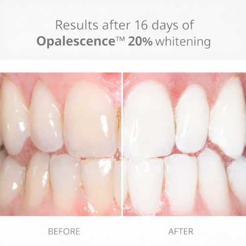 Opalescence 20% with PF Gel Syringes Teeth Whitening - Refill Kit (12 Syringes) Carbamide Peroxide. Made by Ultradent, in Melon Flavor. Tooth Whitening 5401-6