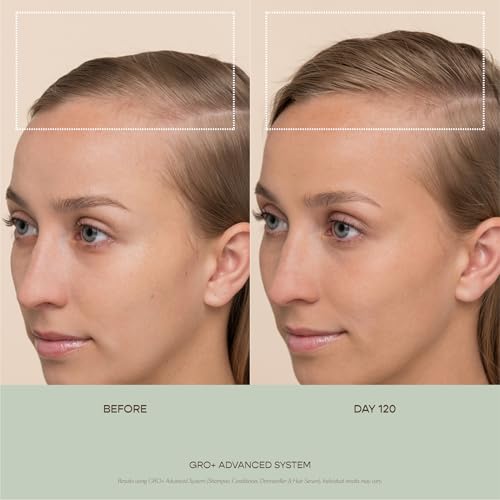 VEGAMOUR GRO+ Advanced Dermaroller | 1,200 Microneedle 0.25mm Scalp Tool | Gently Exfoliates the Scalp | Wide Head for Maximum Coverage