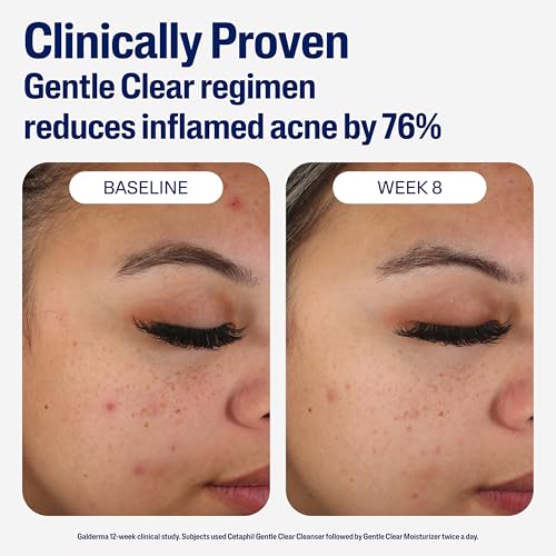 Cetaphil Face Moisturizer, Gentle Clear Mattifying Acne Moisturizer With 0.5% Salicylic Acid, Hydrates and Treats Sensitive Acne Prone Skin, Skin Care for Sensitive Skin, 3oz