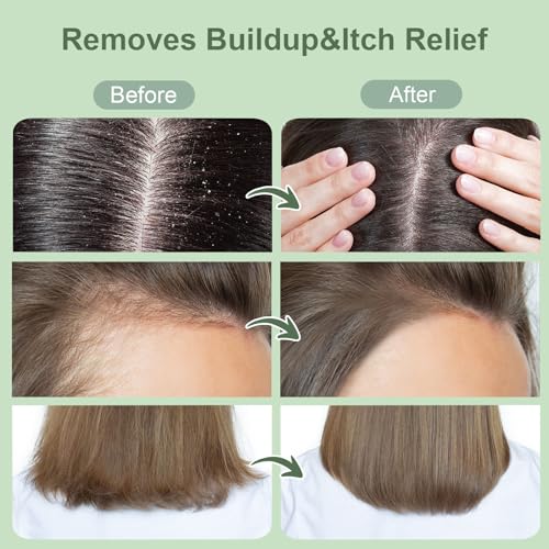 Scalp Scrub, Rosemary & Mint Oil & Biotin Scalp Exfoliator Scrub Shampoo with Silicone Cleansing Massager, Hair Treatment for Itchy Scalp, Dandruff & Buildup Removal & Thick and Strong Hair Growth