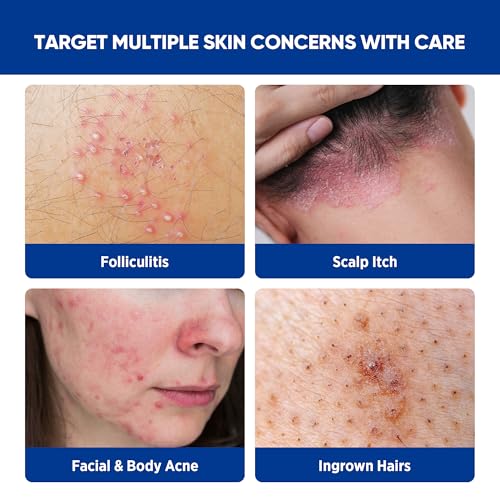 Folliculitis & Acne Treatment Cream – Salicylic Acid & Herbal Extracts for Scalp, Face, Body & Back – Soothes Irritated Skin, Redness & Itch Relief – 100g (Pack of 1)