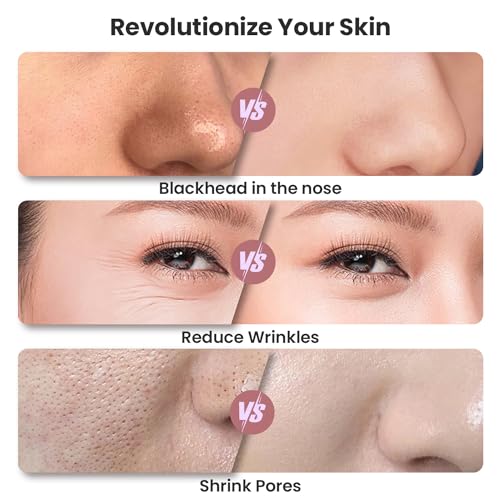 UNOISETION Diamond Microdermabrasion Machine, Portable Blackhead Remover Pore Vacuum, Dermabrasion Facial Machine for Exfoliation & Blackhead Removal