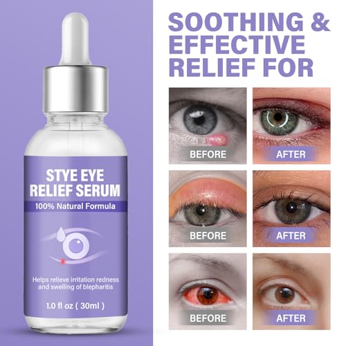 Stye Eye Treatment, Eye Reflief Serum for Styes and Chalazions, Natural & Non-Irritating, Fast-Acting Soothing and Restores Healthier Skin, 30ml