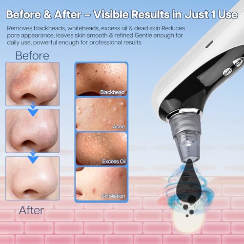 Heated Pore Vacuum, Blackhead Remover with Strong 3-Level Suction, 5 Nozzles for Deep Cleaning Face, Nose & Sensitive Skin, Professional Pore Extractor & Facial Kit