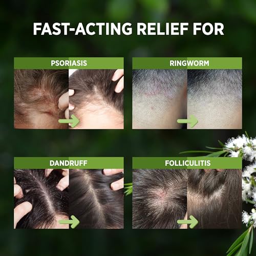 RoyceDerm Tea Tree Scalp Relief Spray - for Comfort, Hydration, and Balance - Conditioning Support for Women & Men