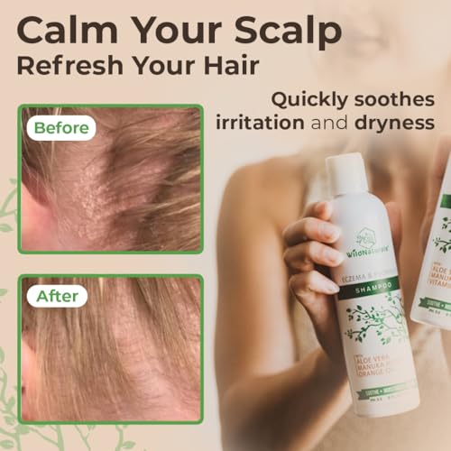 Wild Naturals Eczema & Psoriasis Shampoo – Anti-Dandruff Relief for Dry, Itchy Scalp – Hypoallergenic, Fragrance-Free Formula for Sensitive Scalp