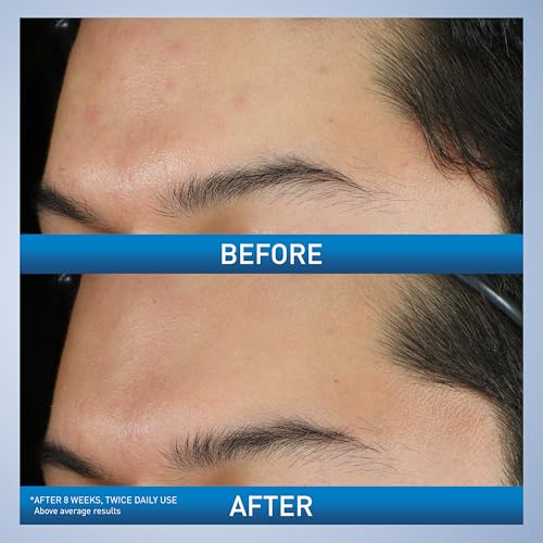 CeraVe Acne Foaming Cream Wash, Gentle Face and Body Cleanser with Benzoyl Peroxide 10%, Hyaluronic Acid, and Niacinamide, 10% Benzoyl Peroxide Treatment Clears Pimples and Blackheads 5 Oz