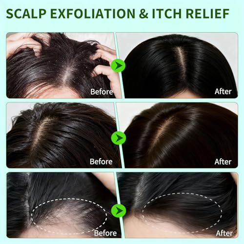 Scalp Scrub,Scalp Exfoliator with Rosemary & Mint,Hair Treatment for Itchy Scalp, Dandruff & Buildup Removal, Clarifying Scrub Shampoo with Scalp Massager for Detox & Nourishment/8.8oz