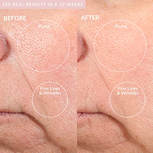 PMD Beauty Personal Microderm Pro - at-Home Use, Facial Exfoliator Tool, Microdermabrasion Machine Kit for Face and Body Skincare, Blush + Starter Kit