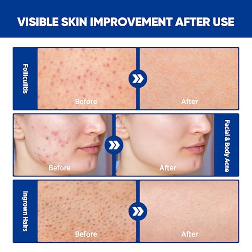 Folliculitis & Acne Treatment Cream – Salicylic Acid & Herbal Extracts for Scalp, Face, Body & Back – Soothes Irritated Skin, Redness & Itch Relief – 100g (Pack of 1)