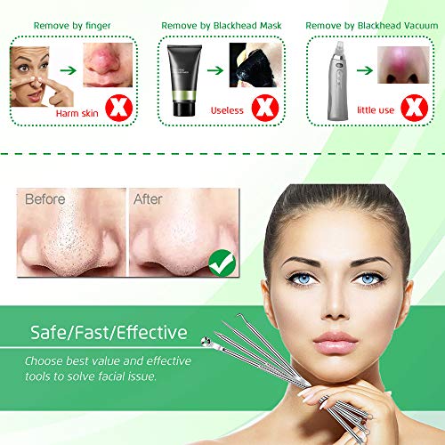 5PCS Blackhead Remover Comedone Extractor, Curved Blackhead Tweezers Kit, Professional Stainless Pimple Acne Blemish Removal Tools Kit for Manual