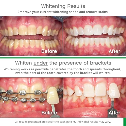Opalescence Go 10% Whitening Bundle - (10 Treatments) Hydrogen Peroxide 10% Prefilled Whitening Trays and Whitening Toothpaste - Made by Ultradent Products. Teeth Whitening Kit -Mint- 5194-5166