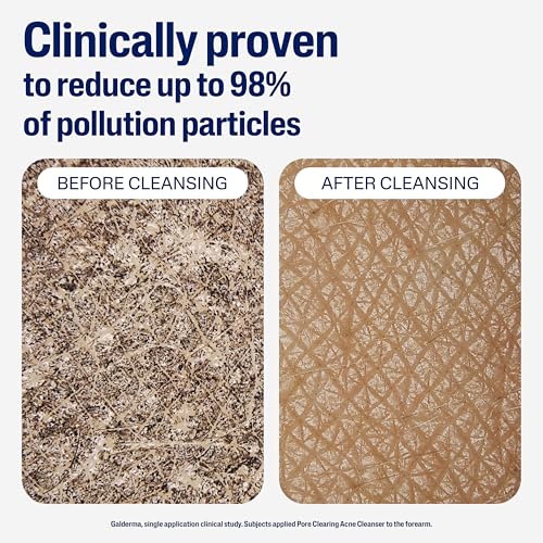 Cetaphil Gentle Clear Pore Clearing Acne Cleanser, Foaming Gel Cleanser for Sensitive, Acne-Prone Skin, 8 Fl Oz Pump Bottle, 2% Salicylic Acid, Gently Exfoliates, Dermatologist Recommended Brand